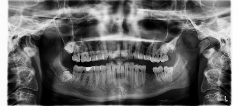 X-ray